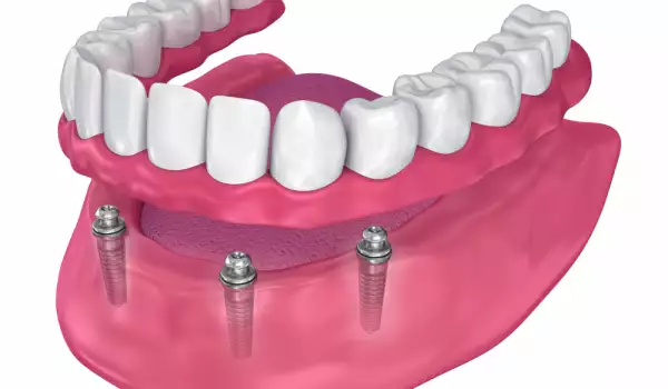 Колко години издържа зъбният имплант?