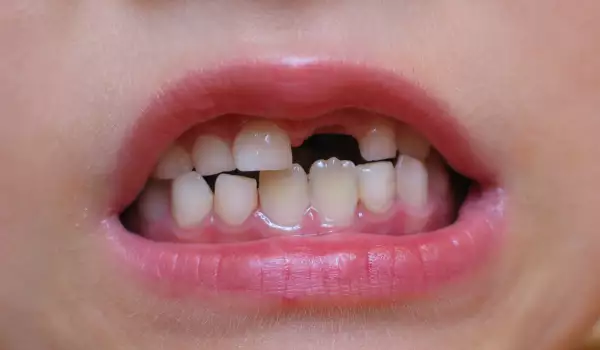 Как да извадим млечен зъб