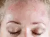 Причини за зачервяване на лицето